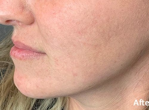 Morpheus8 RF Microneedling Before and After - Case 6, Image 2 - Female, age 18 – 24 - Fortville, IN - PRANA IV Hydration & Wellness Clinic