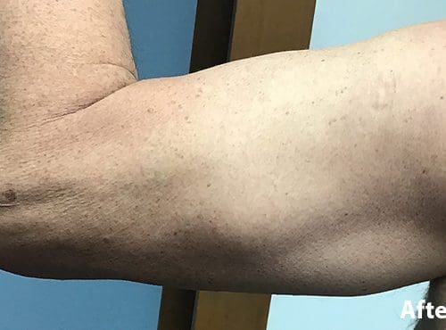 Morpheus8 RF Microneedling Before and After - Case 5, Image 2 - Female, age 45 – 54 - Fortville, IN - PRANA IV Hydration & Wellness Clinic