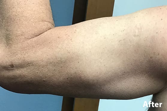 Morpheus8 RF Microneedling Before and After - Case 5, Image 2 - Female, age 45 – 54 - Fortville, IN - PRANA IV Hydration & Wellness Clinic