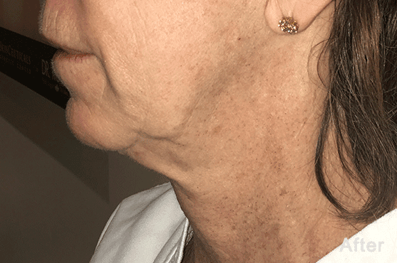 Morpheus8 RF Microneedling Before and After - Case 4, Image 2 - Female, age 55 – 64 - Fortville, IN - PRANA IV Hydration & Wellness Clinic