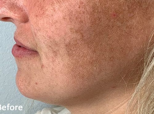 Morpheus8 RF Microneedling Before and After - Case 6, Image 1 - Female, age 18 – 24 - Fortville, IN - PRANA IV Hydration & Wellness Clinic