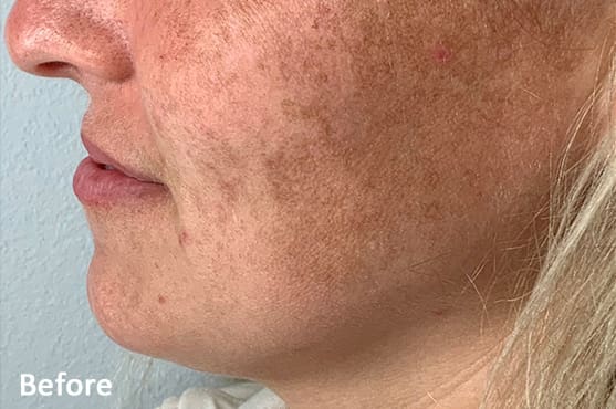 Morpheus8 RF Microneedling Before and After - Case 6, Image 1 - Female, age 18 – 24 - Fortville, IN - PRANA IV Hydration & Wellness Clinic