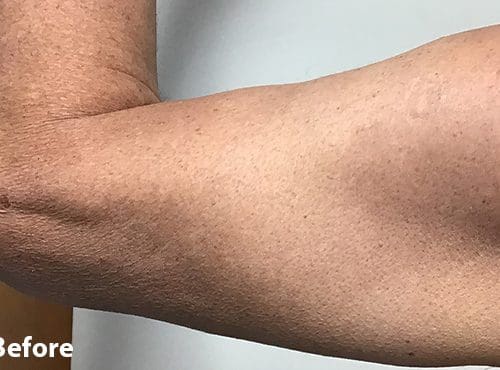 Morpheus8 RF Microneedling Before and After - Case 5, Image 1 - Female, age 45 – 54 - Fortville, IN - PRANA IV Hydration & Wellness Clinic
