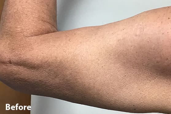 Morpheus8 RF Microneedling Before and After - Case 5, Image 1 - Female, age 45 – 54 - Fortville, IN - PRANA IV Hydration & Wellness Clinic