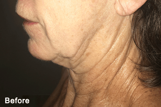 Morpheus8 RF Microneedling Before and After - Case 4, Image 1 - Female, age 55 – 64 - Fortville, IN - PRANA IV Hydration & Wellness Clinic