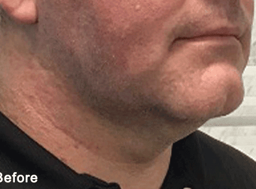 Morpheus8 RF Microneedling Before and After - Case 3, Image 1 - Male, age 35 – 44 - Fortville, IN - PRANA IV Hydration & Wellness Clinic