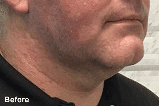 Morpheus8 RF Microneedling Before and After - Case 3, Image 1 - Male, age 35 – 44 - Fortville, IN - PRANA IV Hydration & Wellness Clinic