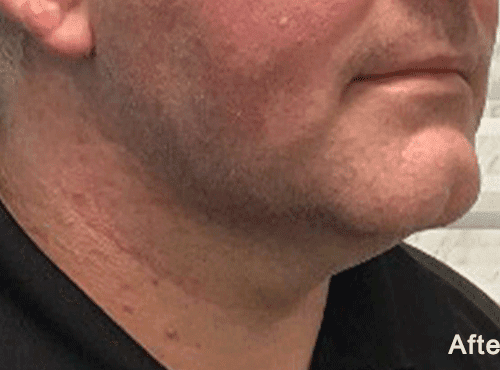 Morpheus8 RF Microneedling Before and After - Case 3, Image 2 - Male, age 35 – 44 - Fortville, IN - PRANA IV Hydration & Wellness Clinic