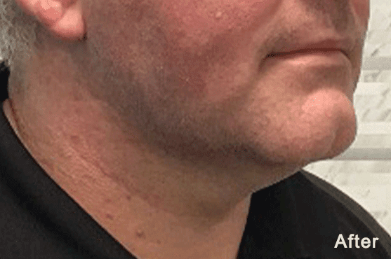Morpheus8 RF Microneedling Before and After - Case 3, Image 2 - Male, age 35 – 44 - Fortville, IN - PRANA IV Hydration & Wellness Clinic