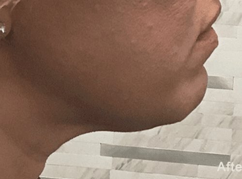 Morpheus8 RF Microneedling Before and After - Case 2, Image 2 - Female, age 25 – 34 - Fortville, IN - PRANA IV Hydration & Wellness Clinic