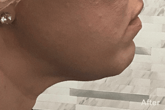 Morpheus8 RF Microneedling Before and After - Case 2, Image 2 - Female, age 25 – 34 - Fortville, IN - PRANA IV Hydration & Wellness Clinic