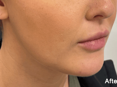 Morpheus8 RF Microneedling Before and After - Case -1, Image 2 - Female, age 25 – 34 - Fortville, IN - PRANA IV Hydration & Wellness Clinic