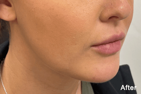 Morpheus8 RF Microneedling Before and After - Case -1, Image 2 - Female, age 25 – 34 - Fortville, IN - PRANA IV Hydration & Wellness Clinic