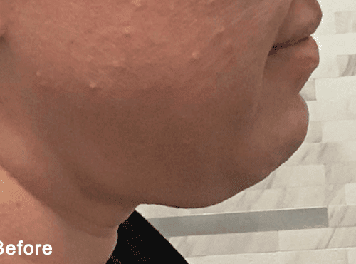 Morpheus8 RF Microneedling Before and After - Case 2, Image 1 - Female, age 25 – 34 - Fortville, IN - PRANA IV Hydration & Wellness Clinic