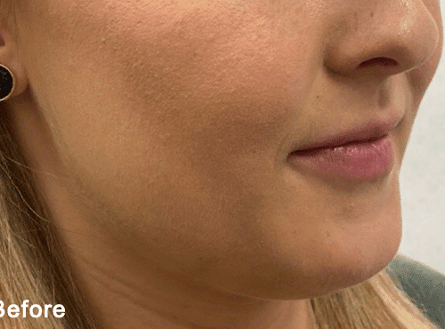 Morpheus8 RF Microneedling Before and After - Case -1, Image 1 - Female, age 25 – 34 - Fortville, IN - PRANA IV Hydration & Wellness Clinic