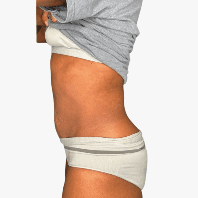 Emsculpt Neo Before and After - Case 5, Image 2 - Female, age 35 – 44 - Fortville, IN - PRANA IV Hydration & Wellness Clinic