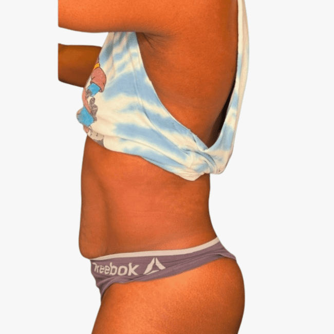 Emsculpt Neo Before and After - Case 5, Image 1 - Female, age 35 – 44 - Fortville, IN - PRANA IV Hydration & Wellness Clinic