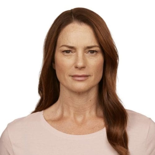 Jeuveau Before and After - Case 2, Image 2 - Female, age 45 – 54 - Fortville, IN - PRANA IV Hydration & Wellness Clinic