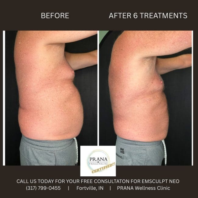 Emsculpt Neo Before and After - Case 11, Image 1 - Male, age 35 – 44 - Fortville, IN - PRANA IV Hydration & Wellness Clinic