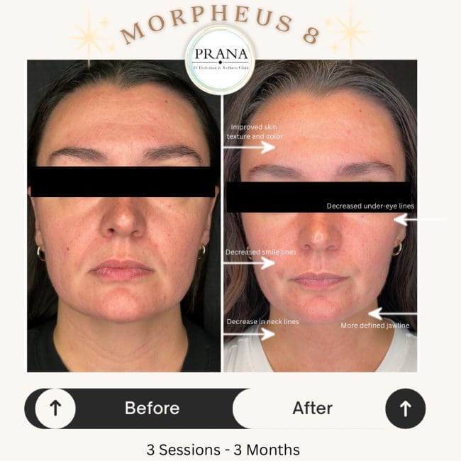 Morpheus8 Before and After - Case -1, Image 1 - Female, age 25 – 34 - Fortville, IN - PRANA IV Hydration & Wellness Clinic