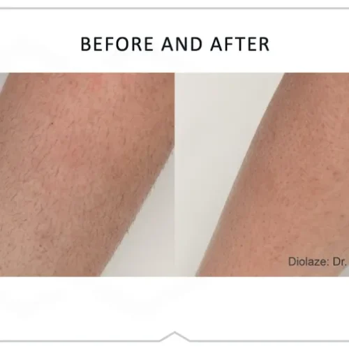 DiolazeXL Before and After - Case 4, Image 1 - Female, age 25 – 34 - Fortville, IN - PRANA IV Hydration & Wellness Clinic