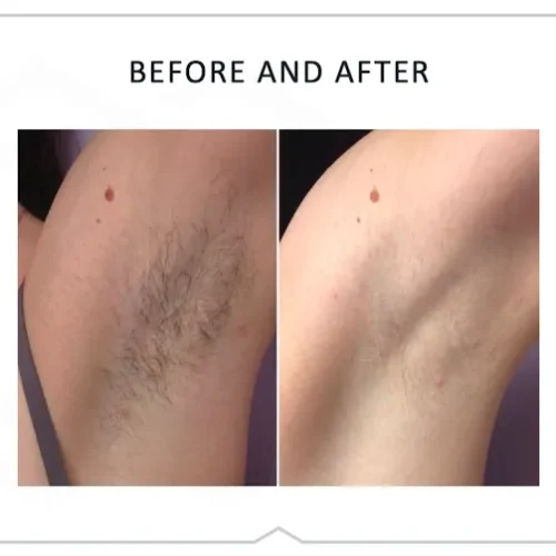 DiolazeXL Before and After - Case -1, Image 1 - Female, age 25 – 34 - Fortville, IN - PRANA IV Hydration & Wellness Clinic