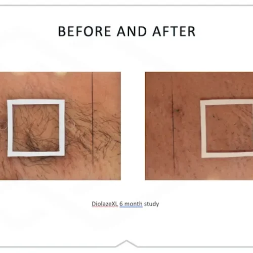 DiolazeXL Before and After - Case 2, Image 1 - Female, age 25 – 34 - Fortville, IN - PRANA IV Hydration & Wellness Clinic