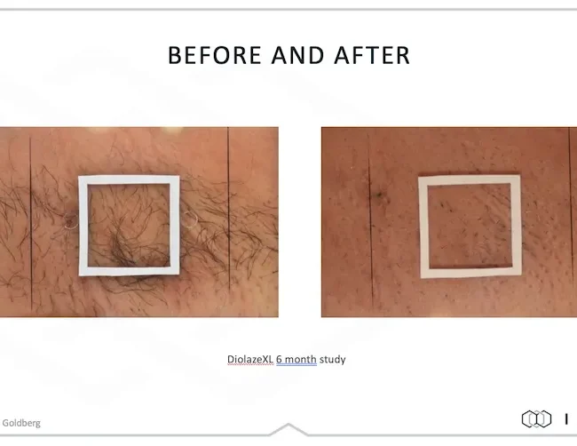 DiolazeXL Before and After - Case 2, Image 1 - Female, age 25 – 34 - Fortville, IN - PRANA IV Hydration & Wellness Clinic