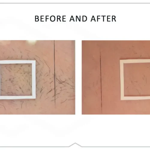 DiolazeXL Before and After - Case 3, Image 1 - Female, age 25 – 34 - Fortville, IN - PRANA IV Hydration & Wellness Clinic