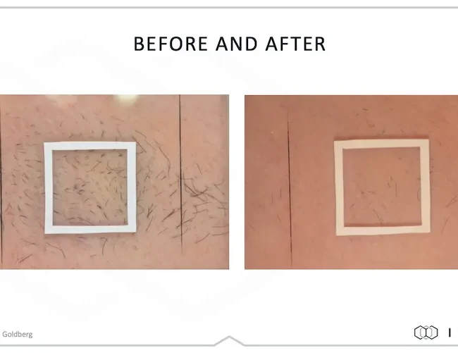 DiolazeXL Before and After - Case 3, Image 1 - Female, age 25 – 34 - Fortville, IN - PRANA IV Hydration & Wellness Clinic