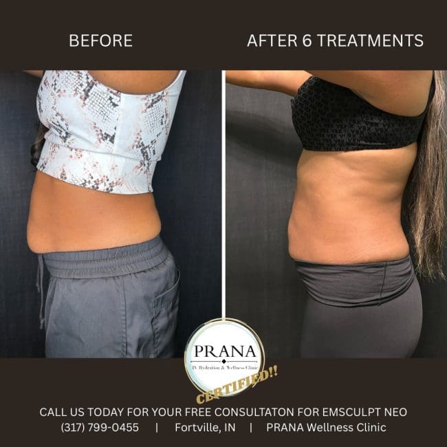 Emsculpt Neo Before and After - Case 13, Image 1 - Female, age 25 – 34 - Fortville, IN - PRANA IV Hydration & Wellness Clinic