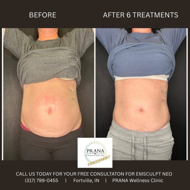 Emsculpt Neo Before and After - Case 12, Image 1 - Female, age 25 – 34 - Fortville, IN - PRANA IV Hydration & Wellness Clinic