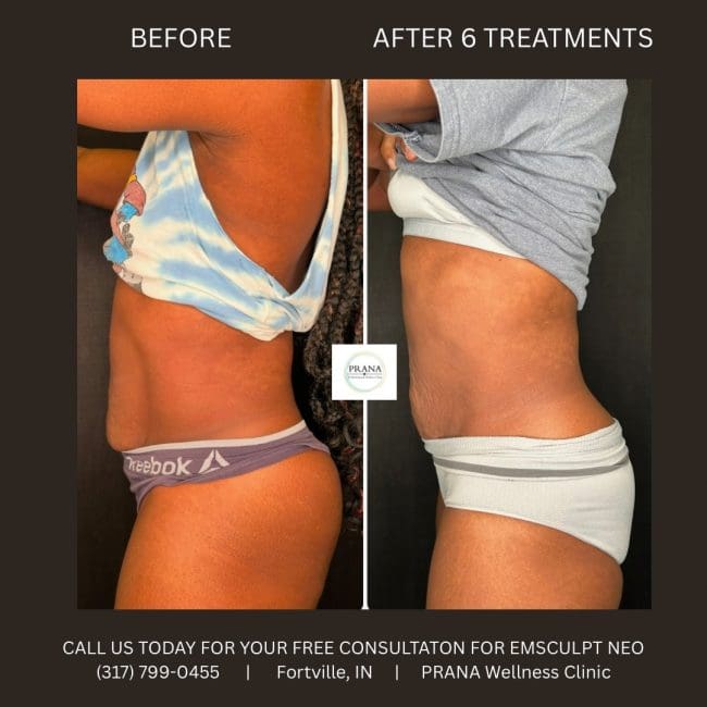 Emsculpt Neo Before and After - Case 17, Image 1 - Female, age 45 – 54 - Fortville, IN - PRANA IV Hydration & Wellness Clinic