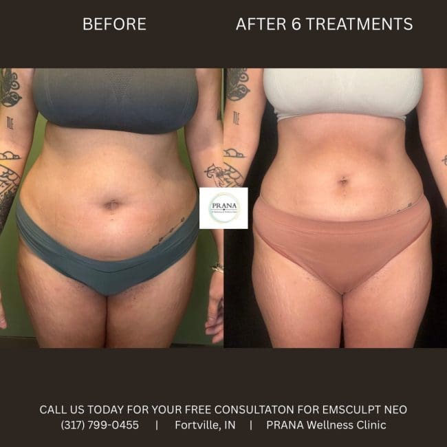 Emsculpt Neo Before and After - Case 15, Image 1 - Female, age 35 – 44 - Fortville, IN - PRANA IV Hydration & Wellness Clinic