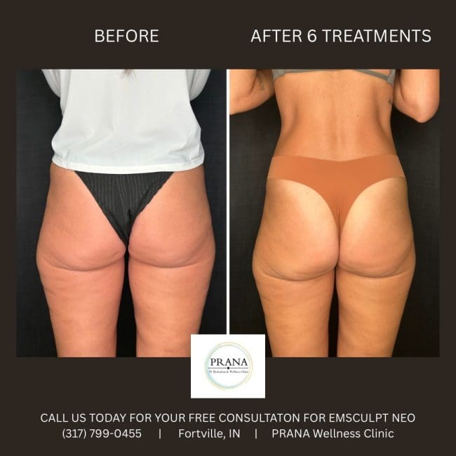 Emsculpt Neo Before and After - Case 16, Image 1 - Female, age 35 – 44 - Fortville, IN - PRANA IV Hydration & Wellness Clinic