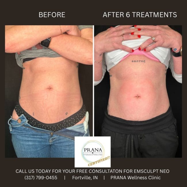 Emsculpt Neo Before and After - Case 21, Image 1 - Female, age 25 – 34 - Fortville, IN - PRANA IV Hydration & Wellness Clinic
