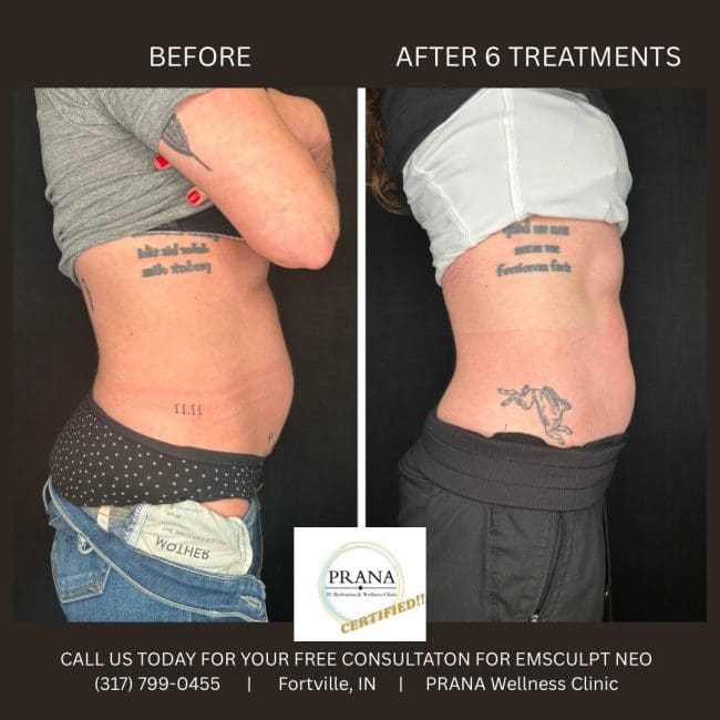 Emsculpt Neo Before and After - Case 22, Image 1 - Female, age 25 – 34 - Fortville, IN - PRANA IV Hydration & Wellness Clinic