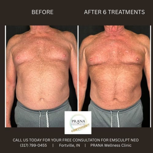 Emsculpt Neo Before and After - Case 23, Image 1 - Male, age 45 – 54 - Fortville, IN - PRANA IV Hydration & Wellness Clinic