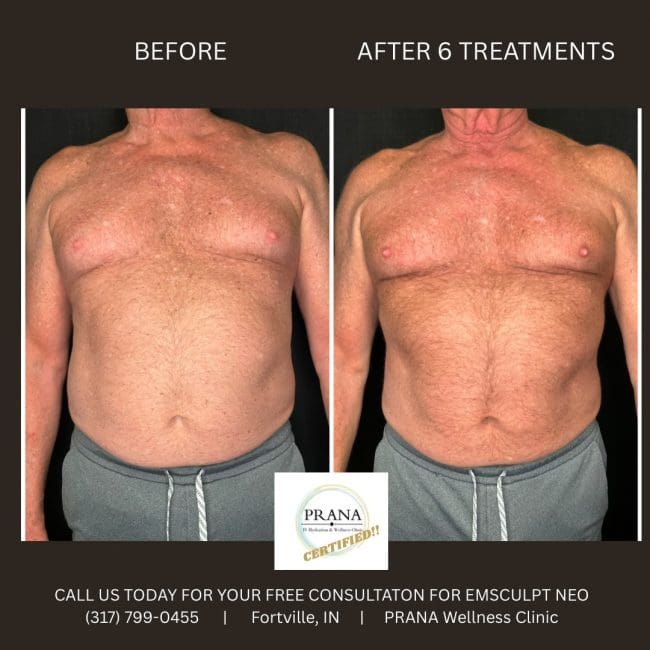 Emsculpt Neo Before and After - Case 23, Image 1 - Male, age 45 – 54 - Fortville, IN - PRANA IV Hydration & Wellness Clinic