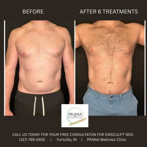 Emsculpt Neo Before and After - Case 24, Image 1 - Male, age 35 – 44 - Fortville, IN - PRANA IV Hydration & Wellness Clinic