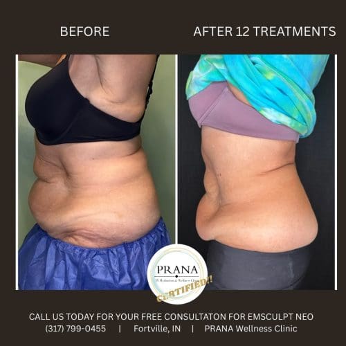Emsculpt Neo Before and After - Case 18, Image 1 - Female, age 45 – 54 - Fortville, IN - PRANA IV Hydration & Wellness Clinic