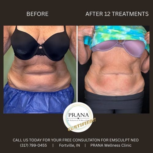 Emsculpt Neo Before and After - Case 25, Image 1 - Female, age 55 – 64 - Fortville, IN - PRANA IV Hydration & Wellness Clinic