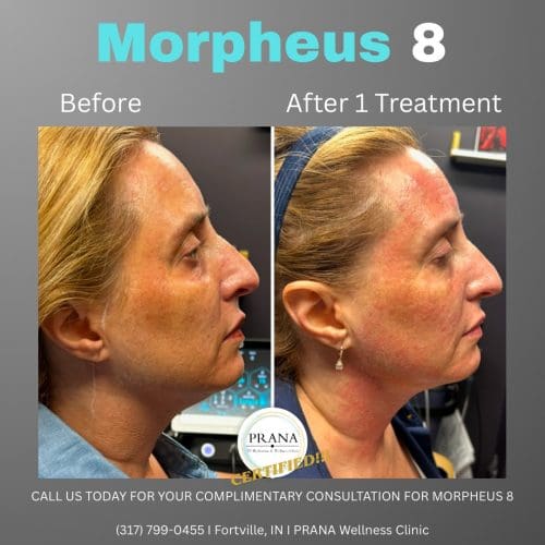 Morpheus8 Before and After - Case 3, Image 1 - Male, age 45 – 54 - Fortville, IN - PRANA IV Hydration & Wellness Clinic
