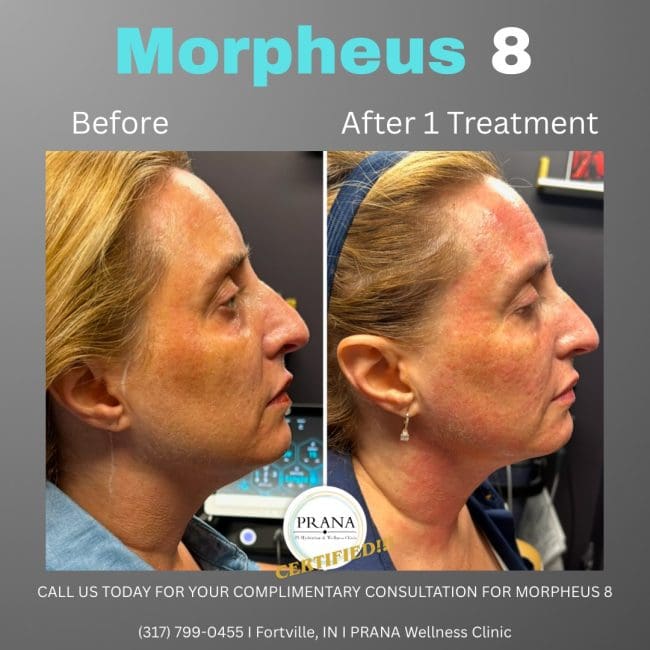 Morpheus8 Before & Afters | PRANA IV Hydration & Wellness Clinic