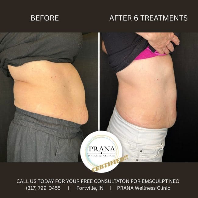 Emsculpt Neo Before and After - Case 20, Image 1 - Female, age 35 – 44 - Fortville, IN - PRANA IV Hydration & Wellness Clinic