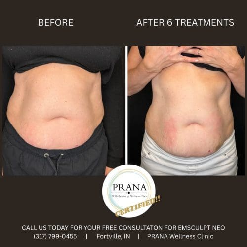Emsculpt Neo Before and After - Case 19, Image 1 - Female, age 35 – 44 - Fortville, IN - PRANA IV Hydration & Wellness Clinic
