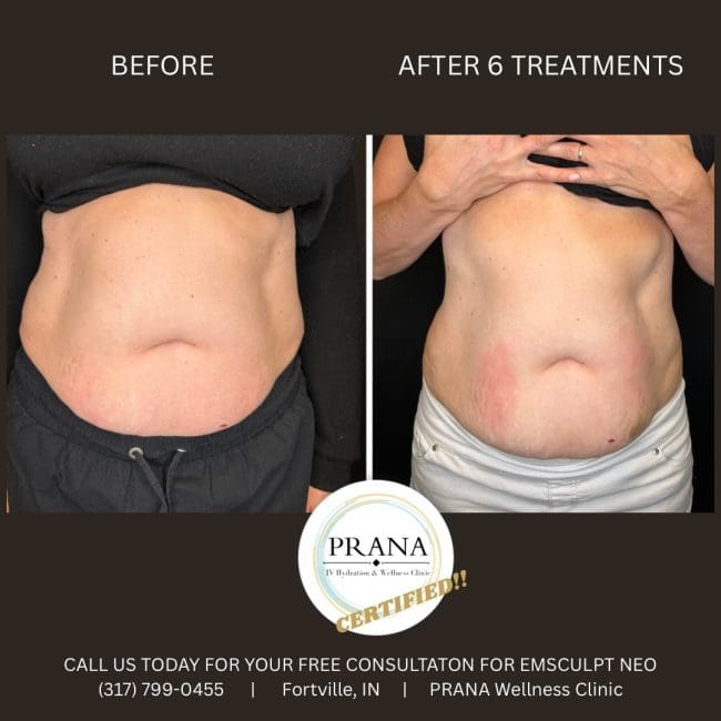 Emsculpt Neo Before and After - Case 19, Image 1 - Female, age 35 – 44 - Fortville, IN - PRANA IV Hydration & Wellness Clinic