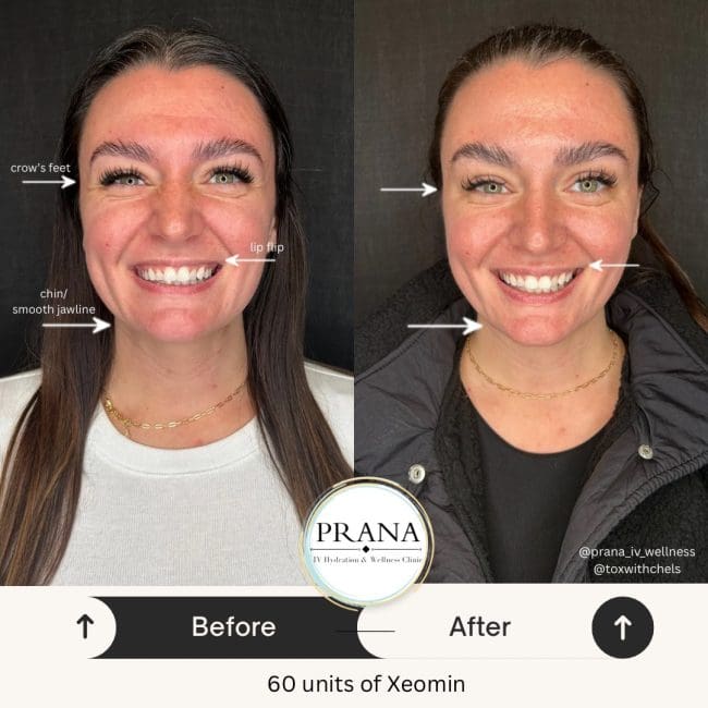 Xeomin Before and After - Case -1, Image 1 - Male, age 25 – 34 - Fortville, IN - PRANA IV Hydration & Wellness Clinic