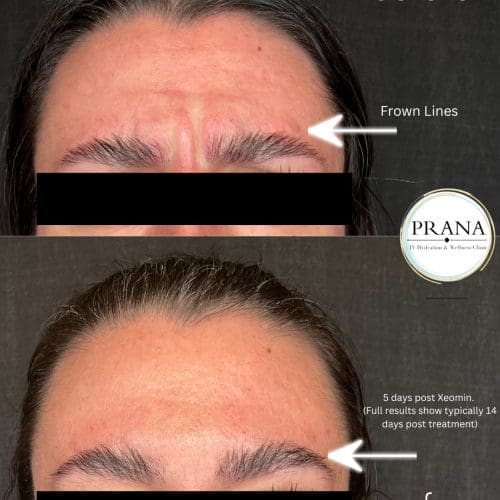 Xeomin Before and After - Case 2, Image 1 - Male, age 25 – 34 - Fortville, IN - PRANA IV Hydration & Wellness Clinic