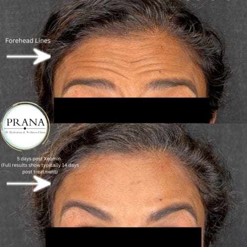 Xeomin Before and After - Case 3, Image 1 - Male, age 25 – 34 - Fortville, IN - PRANA IV Hydration & Wellness Clinic